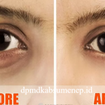 7 Cara Menghilangkan Mata Panda untuk Tampil Lebih Segar