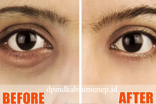 7 Cara Menghilangkan Mata Panda untuk Tampil Lebih Segar